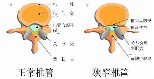 椎管狭窄还能工作吗：影响干活、生育与复活动能力解析