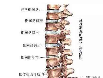 椎管狭窄可以认定工伤吗