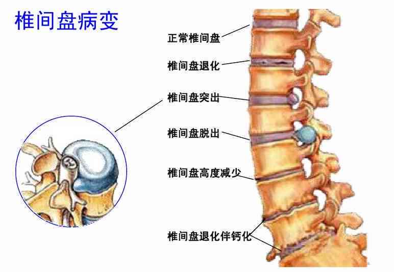 椎管狭窄可以认定工伤吗