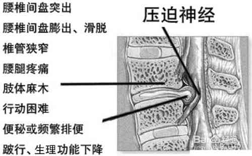 腰椎间盘突出：工作原因导致的损伤能否被认定为工伤事故？