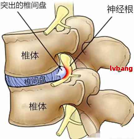 腰椎间盘突出：工作原因导致的损伤能否被认定为工伤事故？