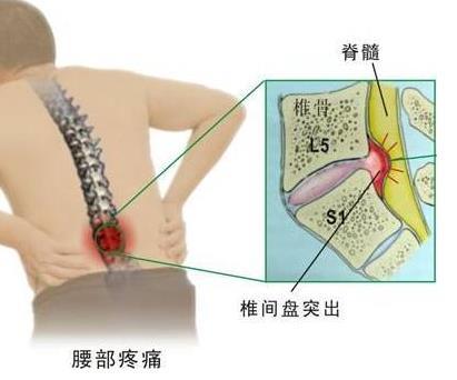 腰椎间盘突出认定工伤：赔偿标准、认定条件、注意事项及伤残鉴定流程