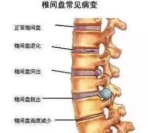 椎间盘膨出能认定工伤嘛赔偿多少及腰椎间盘膨出工伤认定与每日赔偿标准