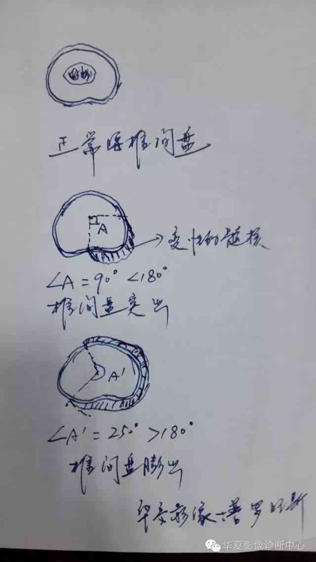 椎间盘膨出是否构成工伤：解析急性外伤导致的工伤认定标准
