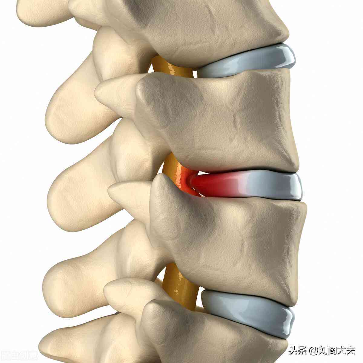 椎间盘膨出是否构成工伤：解析急性外伤导致的工伤认定标准