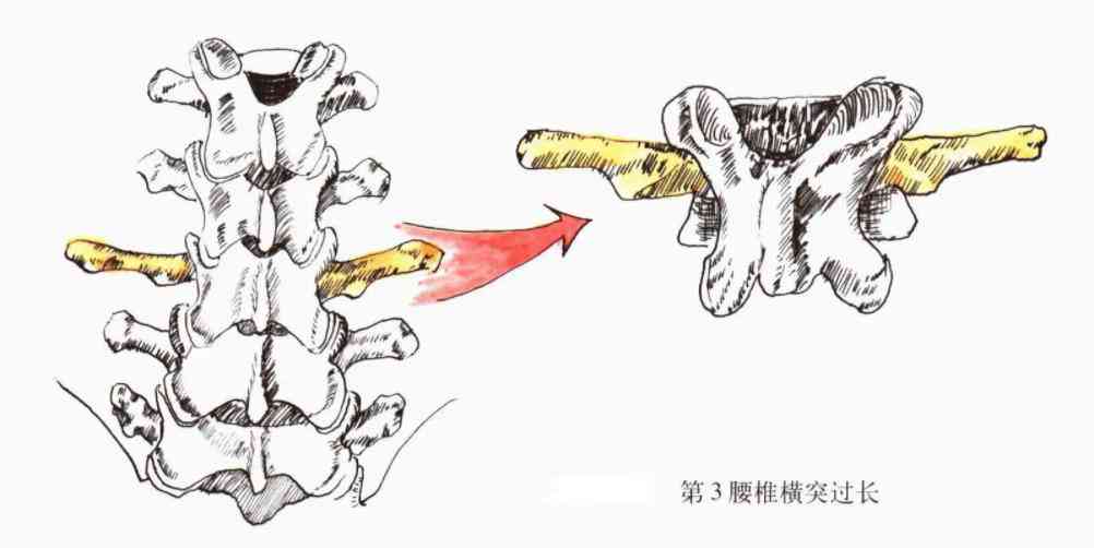 横突综合征严重吗：第三腰椎横突综合征的严重性及影像学表现探究