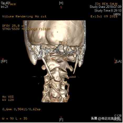 横突综合征严重吗：第三腰椎横突综合征的严重性及影像学表现探究