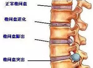 腰椎横突综合征：影像学视角下的特征与诊断要点