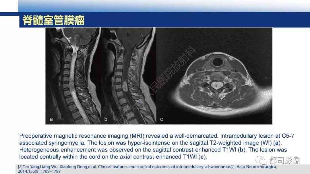 腰椎横突综合征：影像学视角下的特征与诊断要点