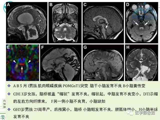 腰椎横突综合征：影像学视角下的特征与诊断要点