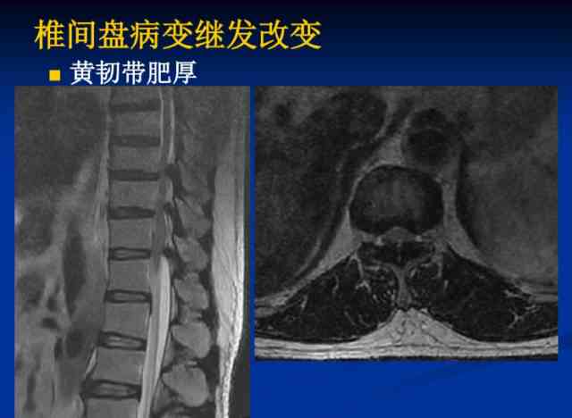 腰椎横突综合征：影像学视角下的特征与诊断要点