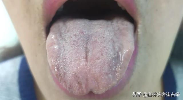 气滞血瘀自我调理与治疗：全方位指南及常见问题解答