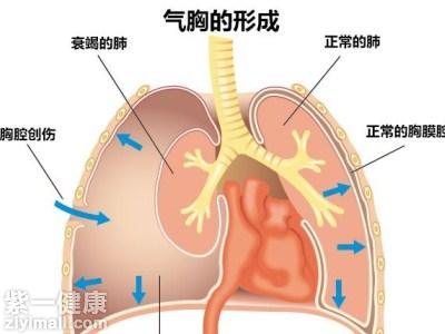工伤认定：如何判定气胸属于职业伤害