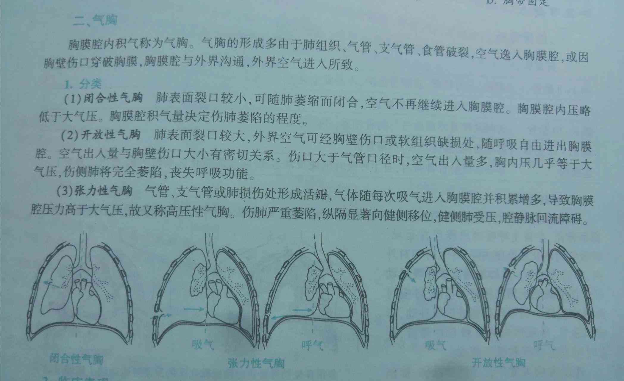 探讨气胸对患者伤残等级评定的具体影响及标准