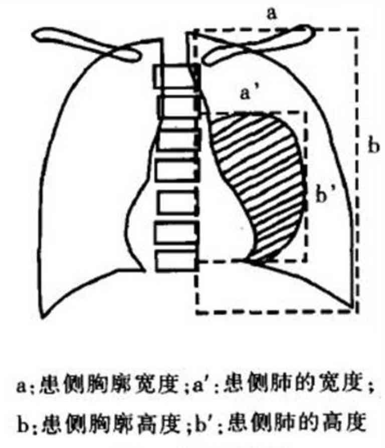探讨气胸对患者伤残等级评定的具体影响及标准