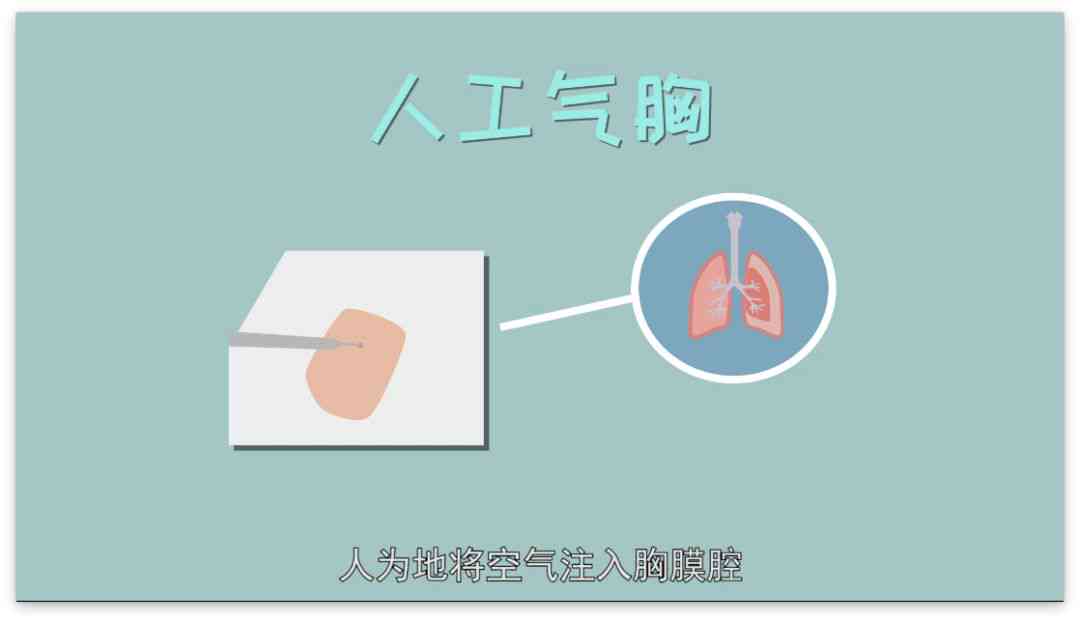 工作中发生的气胸工伤评级及工伤待遇详解