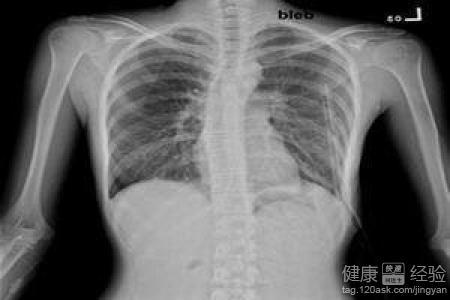 工伤气胸伤残等级认定标准及具体分级