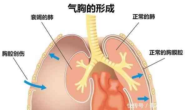 探讨气胸是否被认定为伤残等级的标准与条件