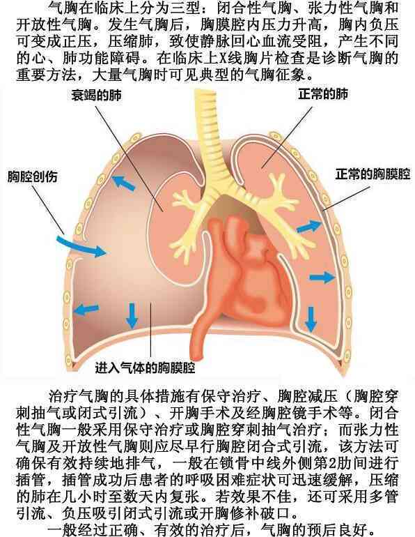 探讨气胸是否属于工伤范畴及其认定标准