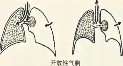 探讨气胸是否属于工伤范畴及其认定标准