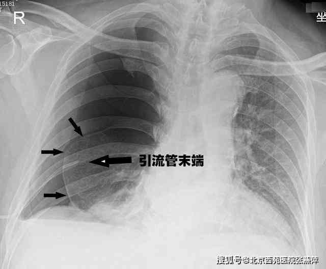 工伤导致的气胸及引流手术后伤残等级认定与赔偿标准解析