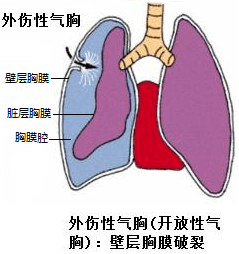 气胸是否被划分为伤残类别及相关政策解读