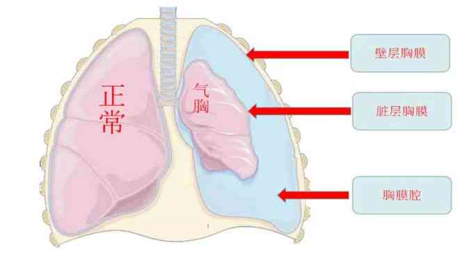 气胸是否被划分为伤残类别及相关政策解读