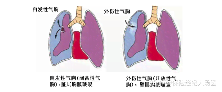 气胸构成轻伤吗：气胸算轻伤害及伤残级别判定
