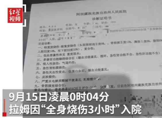 汽油烧伤复周期解析：不同烧伤程度的恢复时间与治疗建议