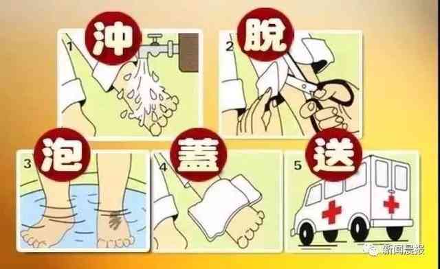 汽油烧伤复周期解析：不同烧伤程度的恢复时间与治疗建议