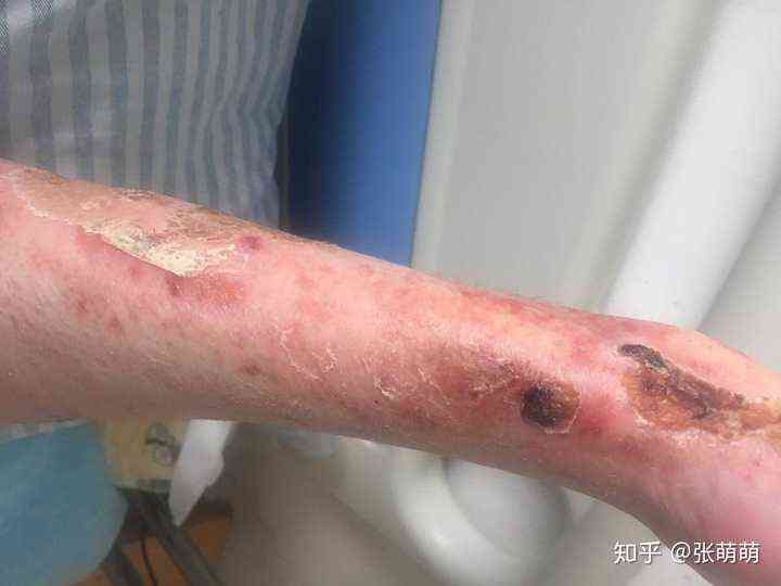 汽油烧伤会留疤吗：皮肤能愈合及如何恢复不留疤？