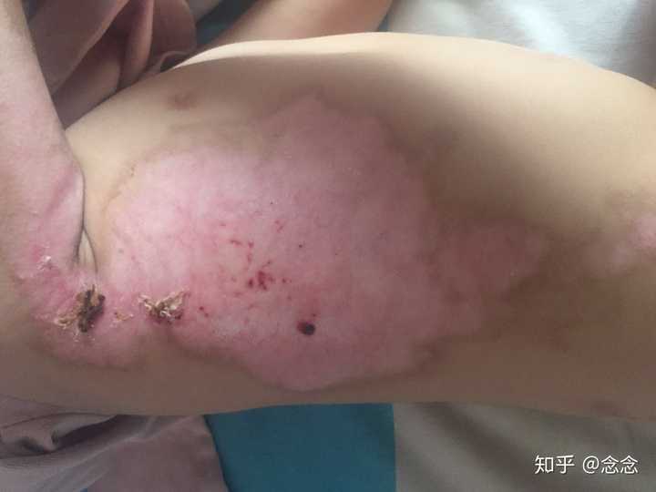 汽油烧伤会留疤吗：皮肤能愈合及如何恢复不留疤？