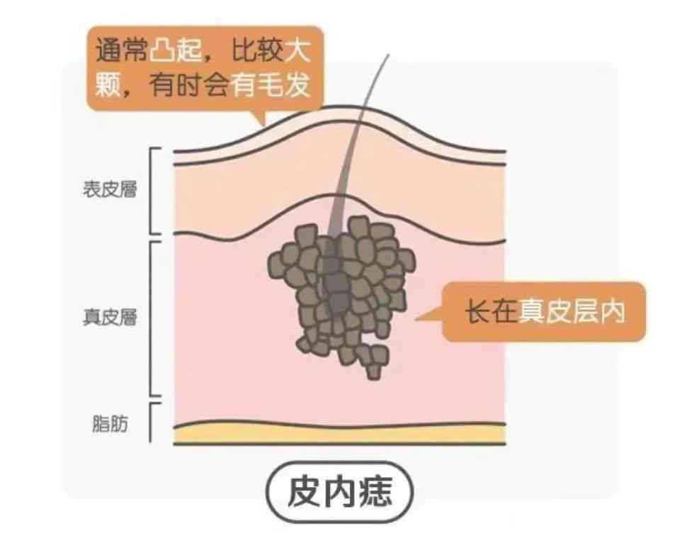 汽油烧伤后皮肤愈合过程与复管理