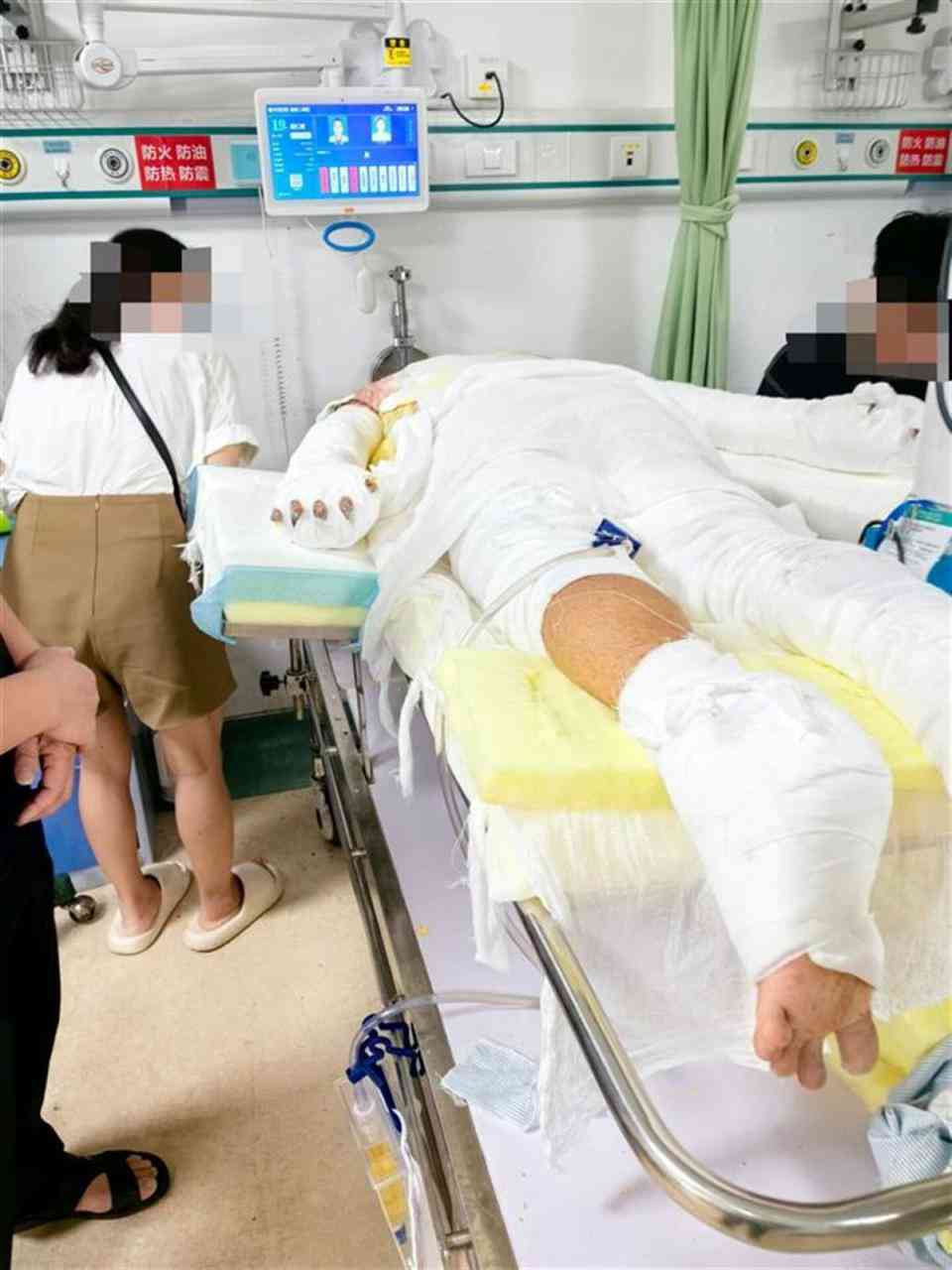 汽油烧伤后皮肤愈合过程与复管理