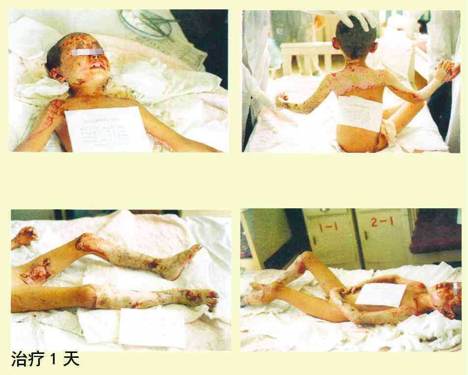 汽油烧伤多久才会好：生命危险与恢复疼痛处理及恢复后照片对比