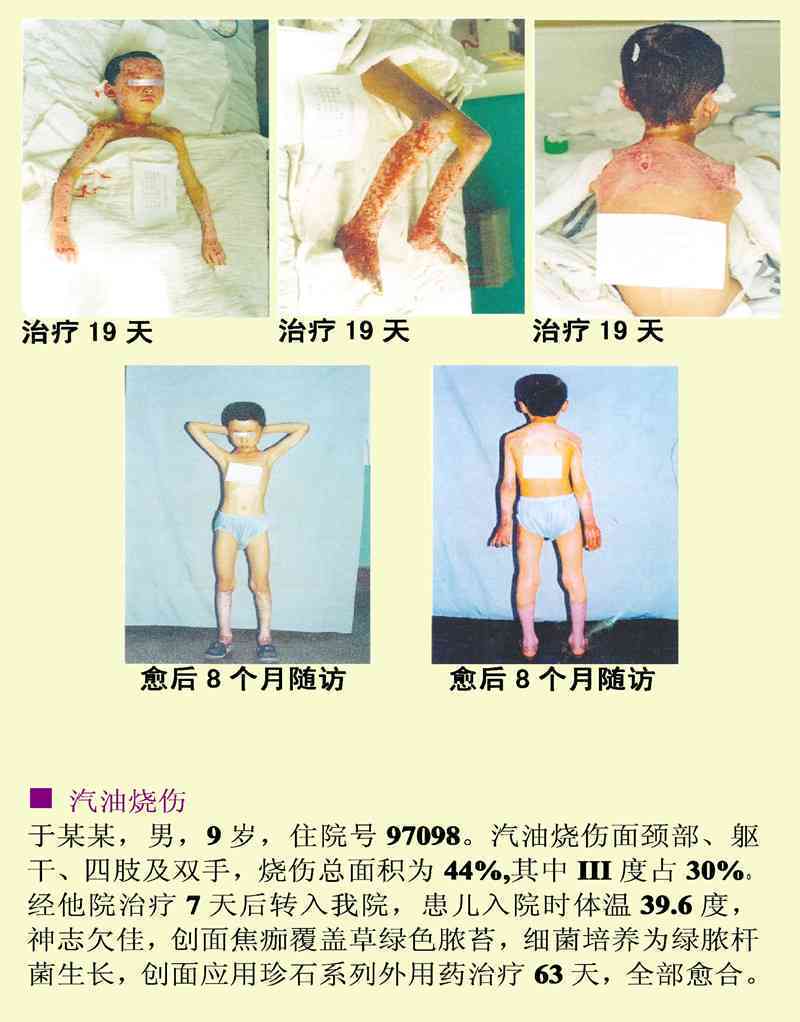 汽油烧伤的风险评估：生命危险的潜在因素与治疗对策全解析
