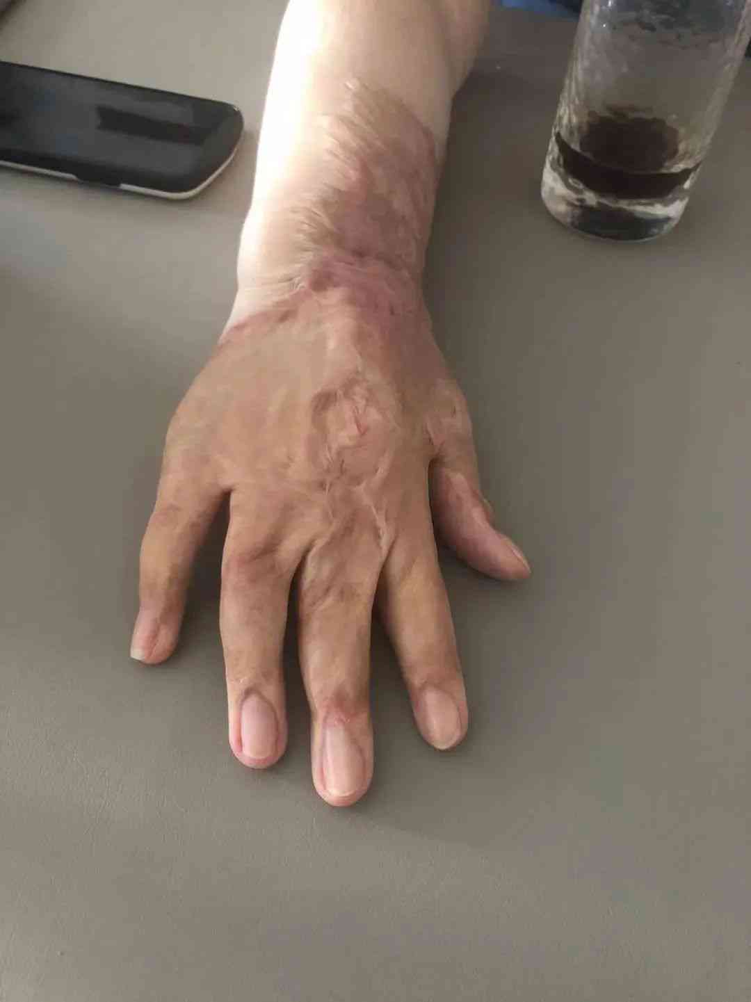 汽油烧伤治愈前后对比照：复历程见证