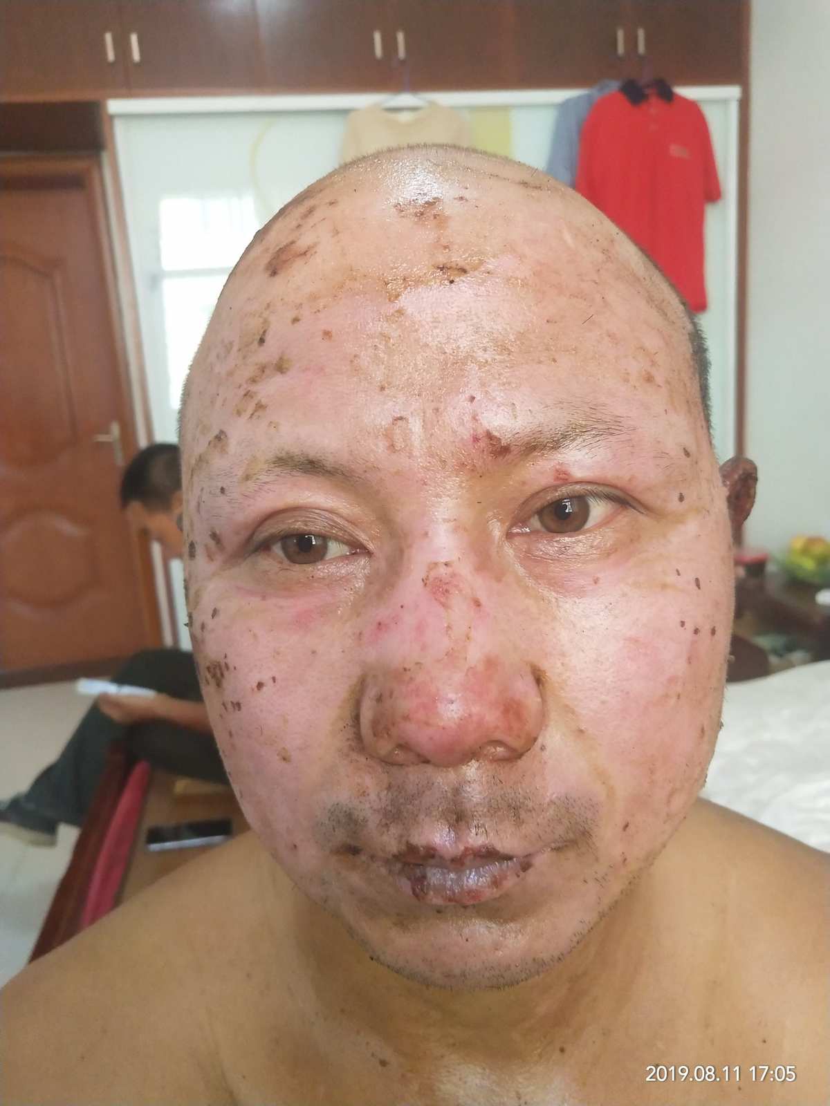 汽油烧伤治愈前后对比照：复历程见证