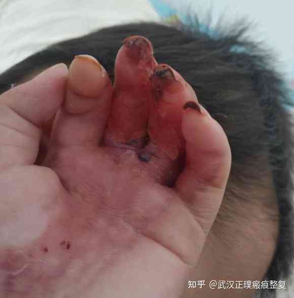疤吗？汽油烧伤后皮肤能否愈合与恢复