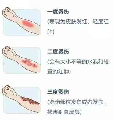 汽油烧伤复周期解析：从急救处理到完全愈合的时间线与注意事项