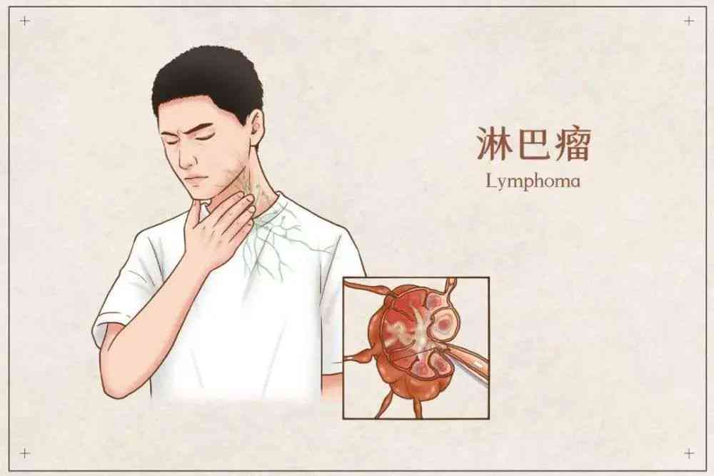 淋巴癌能认定工伤吗
