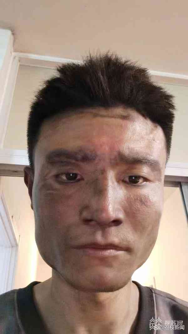火烧着脸怎么认定工伤