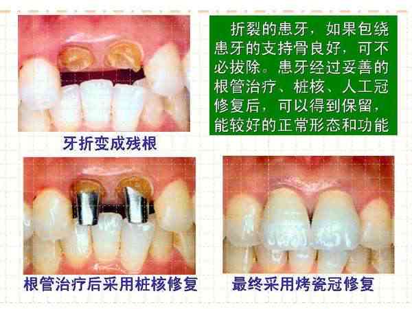 牙冠折裂能否认定工伤伤残