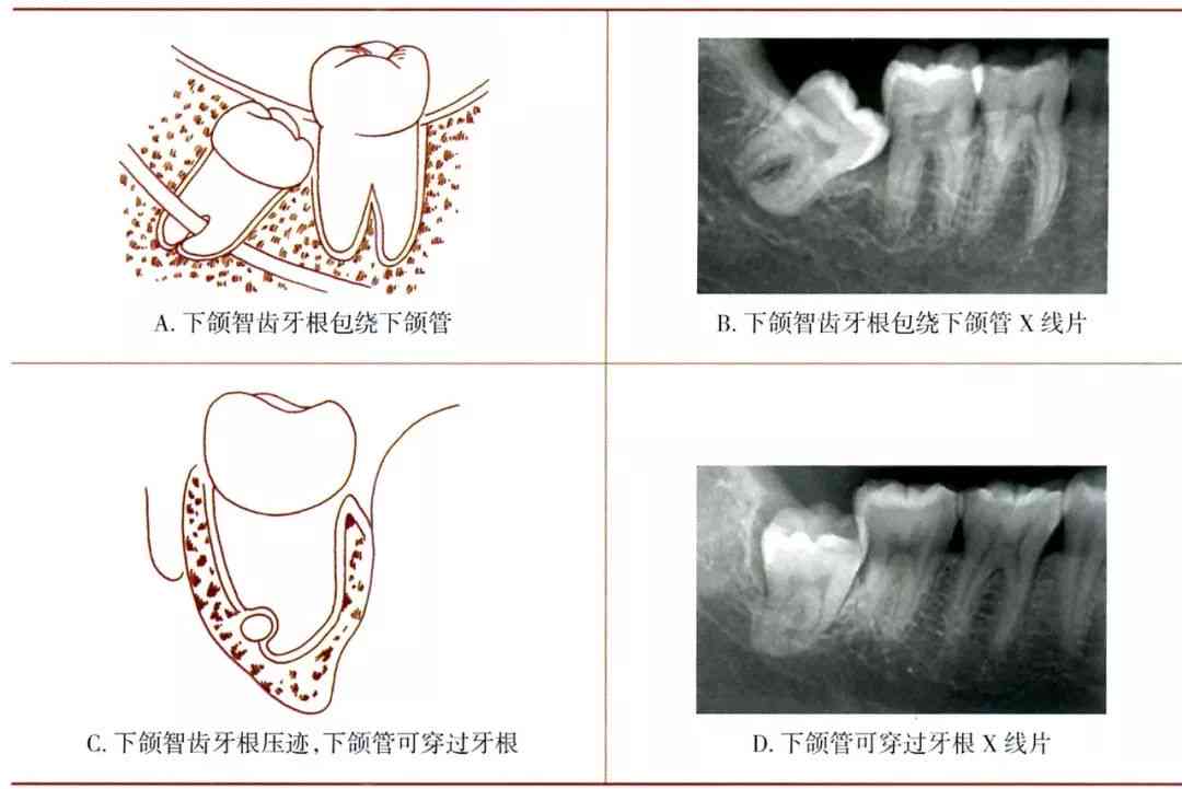 牙齿损伤工伤等级认定标准与赔偿指南：拔牙后的工伤评定全解析