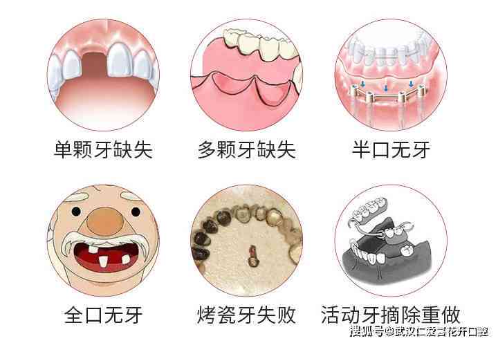 工伤致牙齿脱落评定：工伤牙齿缺失级别鉴定与赔偿标准解析