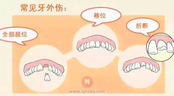 牙齿碰断3颗能认定工伤吗