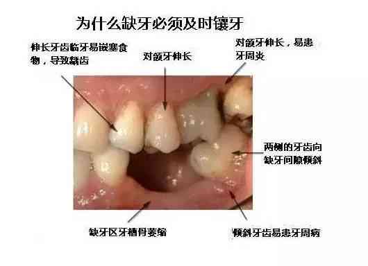 牙齿缺失可以认定工伤吗