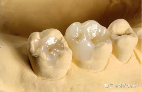 牙齿裂纹修复指南：探讨裂纹牙齿的修补方法与技巧