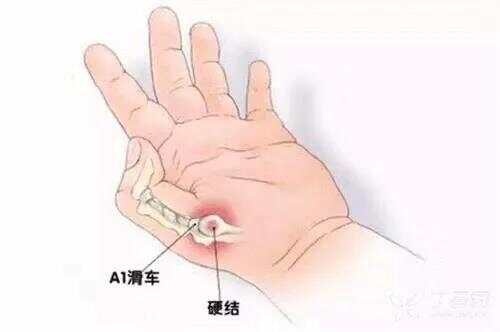 狭窄性腱鞘炎：工伤认定标准及可能的伤残等级划分详解