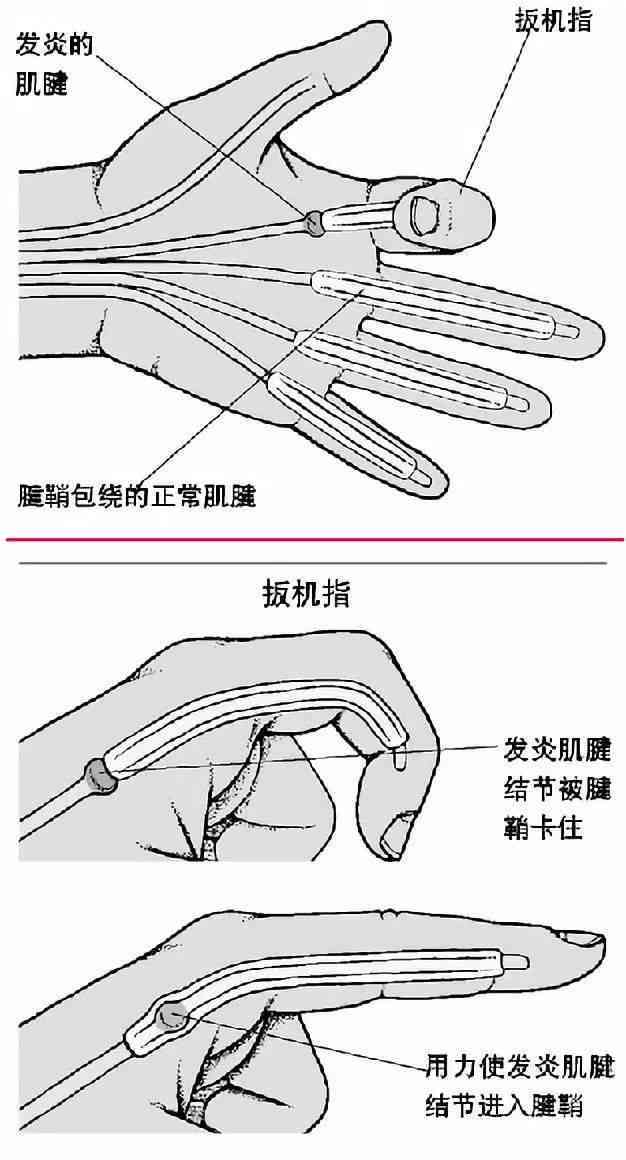 狭窄性腱鞘炎：工伤认定标准及可能的伤残等级划分详解